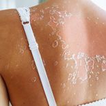 Después de la quemadura, lo ideal es mantener la piel hidratada y usar paños fríos para evitar el ardor. Después de la quemadura, lo ideal es mantener la piel hidratada y usar paños fríos para evitar el ardor.