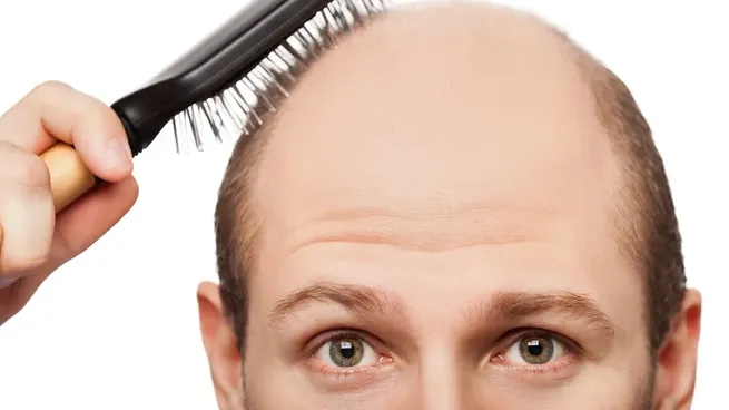 Cada 7 de octubre se conmemora el Día de la calvicie, con el fin de concientizar y normalizar sobre la alopecia.