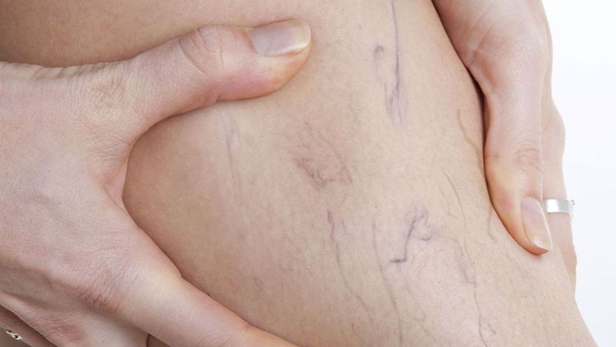 What are the methods to eliminate varicose veins without resorting to surgery