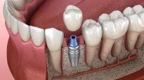 Los riesgos y complicaciones de los implantes dentales, según los especialistas.