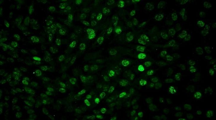 Estudios preclínicos muestran que bloquear la proteína Foxp3 mejora la respuesta del tumor a quimioterapia y radioterapia. Estudios preclínicos muestran que bloquear la proteína Foxp3 mejora la respuesta del tumor a quimioterapia y radioterapia.