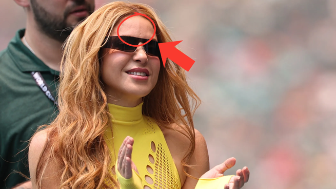 La cicatriz de Shakira.