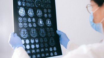 piden prestar atencion a sintomas neurologicos asociados al coronavirus