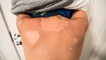 cuidado de la piel en verano: ¿que hacer para no pelarse?