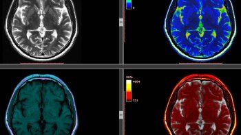Cerebro.