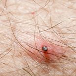 Preocupación en todo México por el avance de esta enfermedad. Preocupación en todo México por el avance de esta enfermedad.