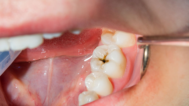 Cómo prevenir las caries, según este remedio de cuidado bucal.