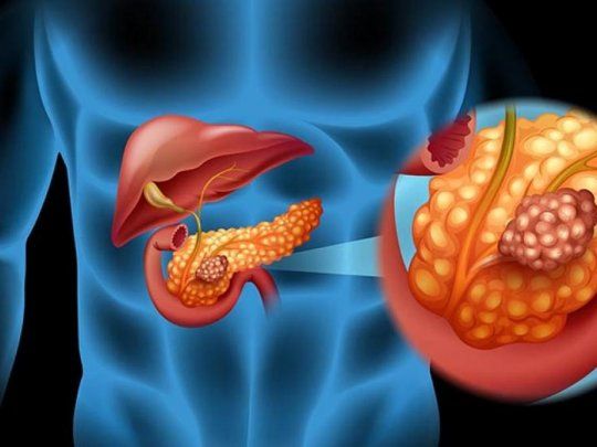 El adenocarcinoma ductal de páncreas es el tipo más habitual de la enfermedad y suele diagnosticarse tarde.