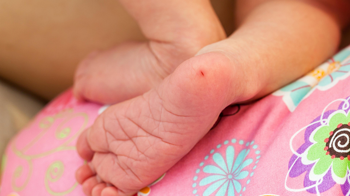 Phenylcetonuria (PKU): a rare disease with preventable consequences