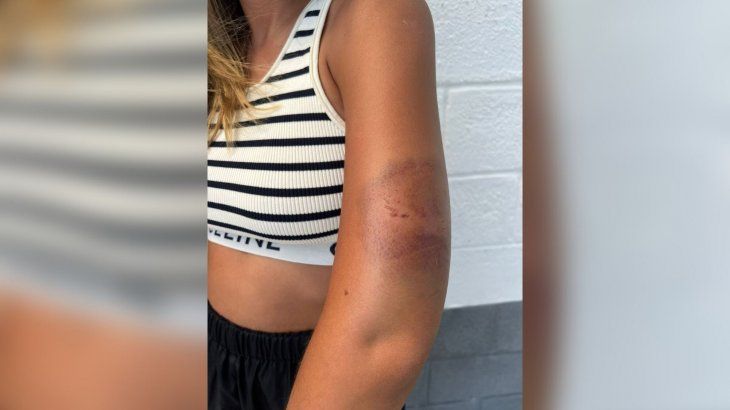 Florencia Sosa fue mordida por uno de los ladrones en Brasil&nbsp;
