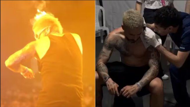 El artista colombiano sufrió quemaduras en uno de sus brazos en pleno recital en Colombia