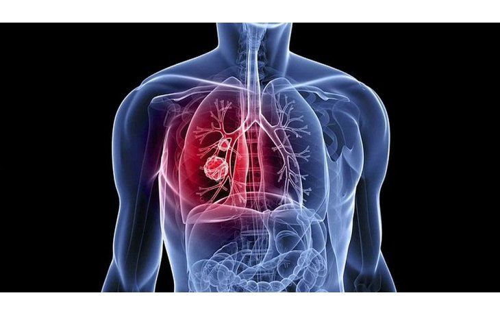 Cáncer de pulmón: uno de los más mortales en el país.