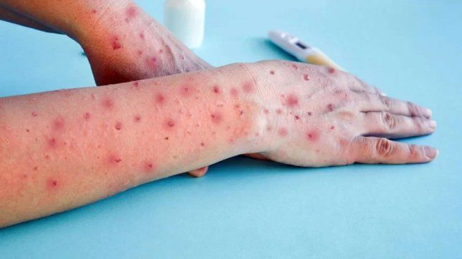 Detectaron nuevos casos de Mpox en la Argentina.