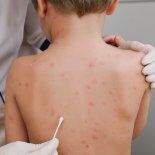 Preocupación por la reaparición de un brote de sarampión. Preocupación por la reaparición de un brote de sarampión.