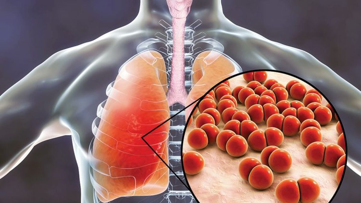 WHO monitors the unknown pneumonia that was registered in Tucumán