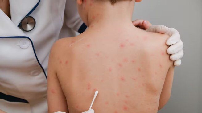 La primera dosis de la Vacuna Triple Viralbrinda una protección del 80%. Con la segunda dosis se alcanza una protección del 97%.
