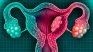 A new study reduces the risk of death in patients with uterine cancer. A new study reduces the risk of death in patients with uterine cancer.