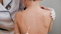 La primera dosis de la Vacuna Triple Viralbrinda una protección del 80%. Con la segunda dosis se alcanza una protección del 97%.
