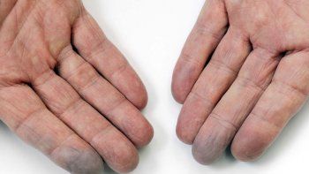Uno de los principales signos de la esclerodermia es el S&iacute;ndrome de Raynaud, en las campa&ntilde;as conocidos como los dedos azules.