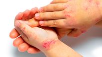 dermatitis atopica, la enfermedad en la piel que no deja dormir a los ninos