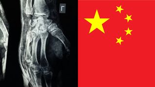 Revolución en ortopedia: un adhesivo biodegradable promete reparar fracturas sin cirugía invasiva.