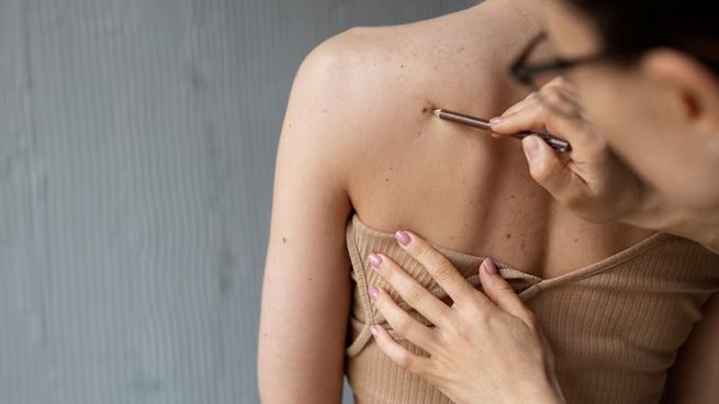 Cada 23 de mayo se conmemora el Día Mundial de Melanoma.