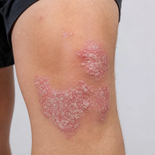 &nbsp;Las lesiones suelen aparecer en codos, rodillas y cuero cabelludo. El diagnóstico dermatológico permite definir el tratamiento según la gravedad.