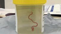 El especimen encontrado en el cerebro de una mujer australiana.