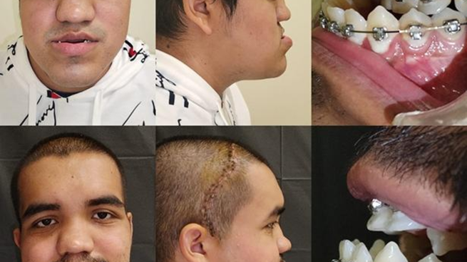 La reconstrucción facial de médicos del IMSS en Nuevo León.