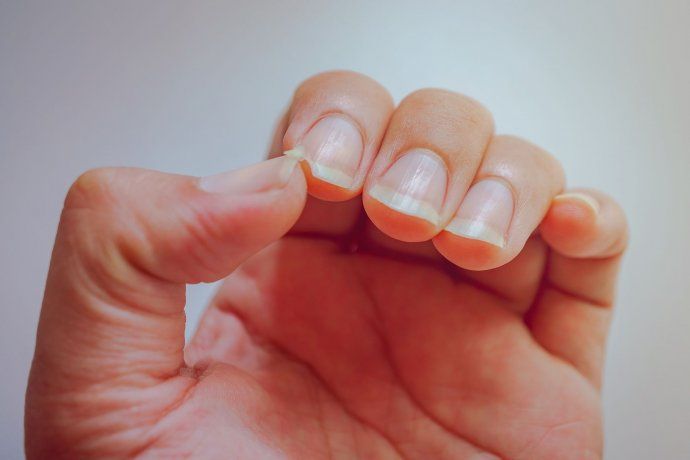 Factors such as nail biting, the use of cleaning products, stress, hypothyroidism, anemia, dermatological diseases or a poor diet can affect them. Factors such as nail biting, the use of cleaning products, stress, hypothyroidism, anemia, dermatological diseases or a poor diet can affect them.