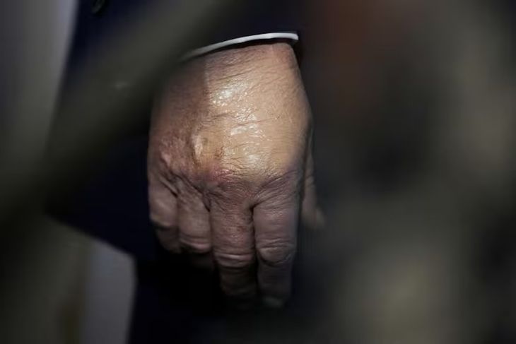 The swelling on Trump's hands has been the subject of speculation.  The swelling in Trump's hands has been the subject of speculation.