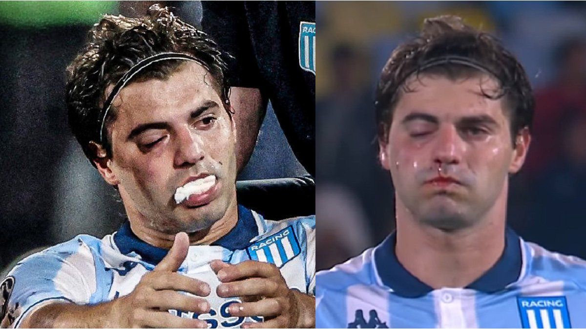 Concern in Racing: Santiago Sosa has a jaw fracture due to Marcos Rojo’s blow and is a doubt for the rematch against Flamengo