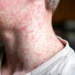 La provincia de Buenos Aires registró 21 casos de sarampión. La provincia de Buenos Aires registró 21 casos de sarampión.