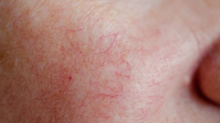 Arañas vasculares en la mejilla. Arañas vasculares en la mejilla.