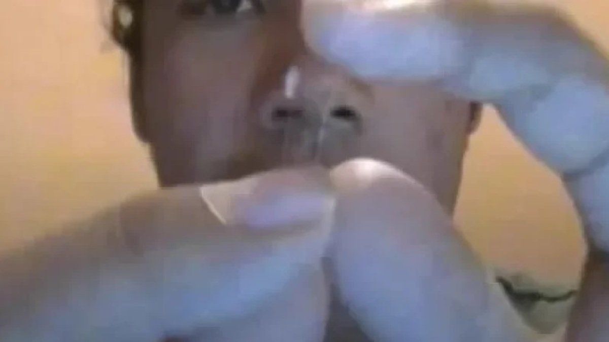 Insólito: quiso operarse la nariz mirando un tutorial en YouTube y terminó internado