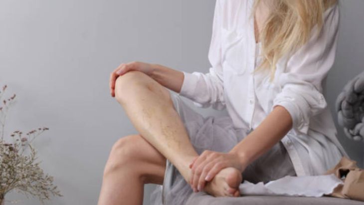 Arañas vasculares en las piernas. Arañas vasculares en las piernas.