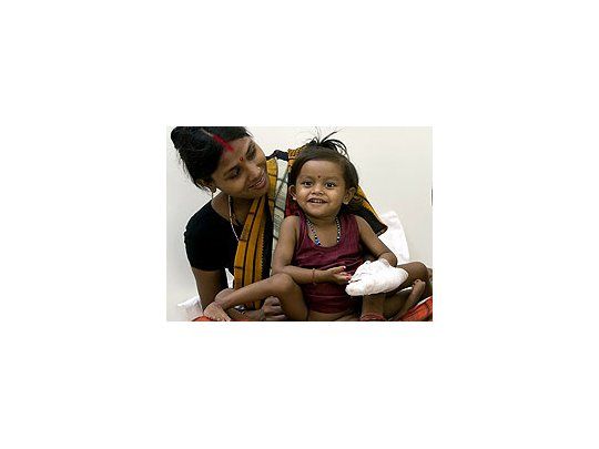 Finalizó con éxito la operación de la niña india que nació con ocho extremidades