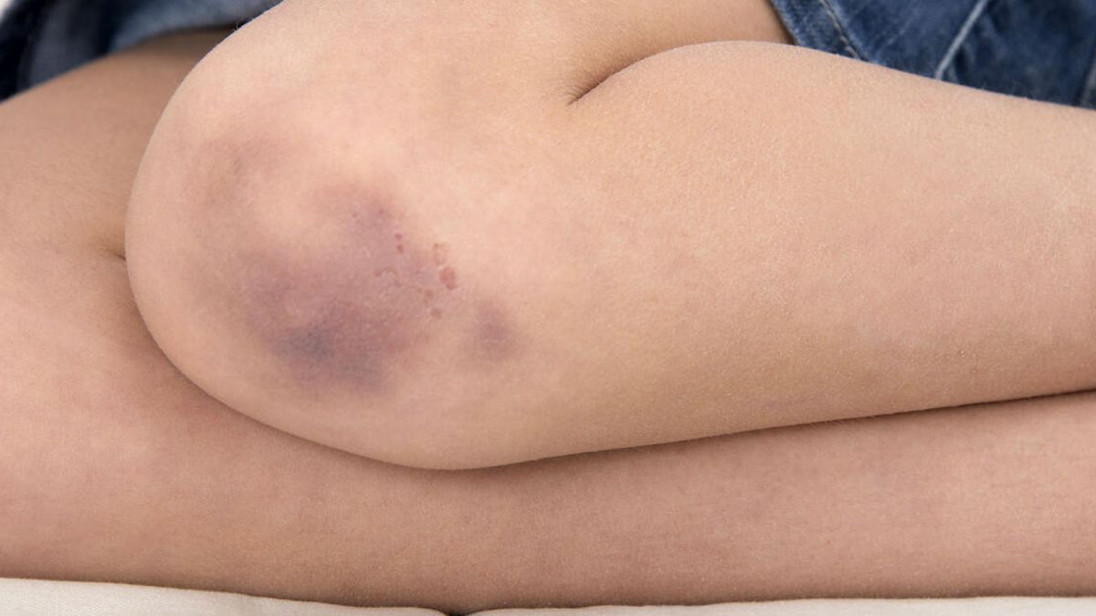 This is the reason you have bruises without hitting yourself