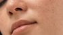 Sun spots or hyperpigmentation are caused by unprotected exposure to the Sun. Sun spots or hyperpigmentation are caused by unprotected exposure to the Sun.