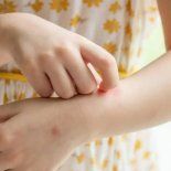 Cómo protegerse del sol y de los mosquitos en el verano. Cómo protegerse del sol y de los mosquitos en el verano.