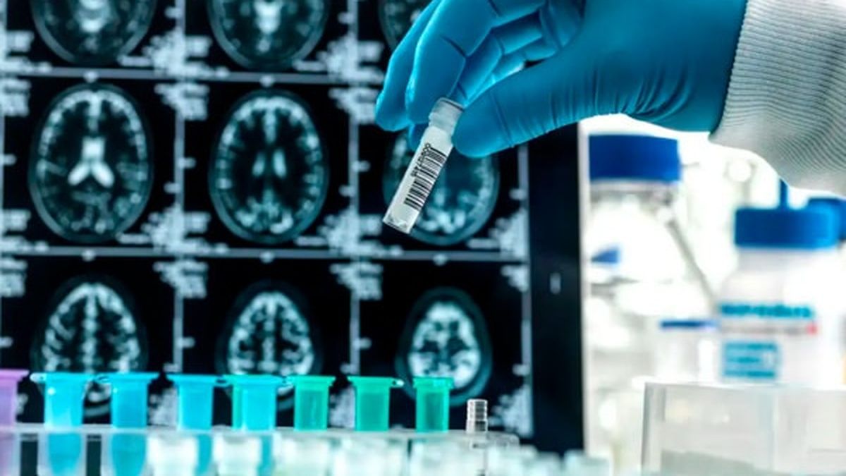 Alzheimer: nuevo fármaco presenta resultados positivos