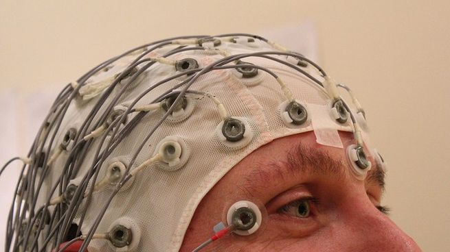 Estimulación Cerebral Profunda.jpg
