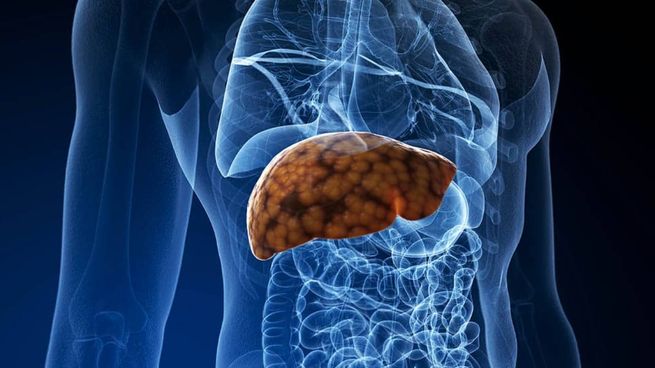 Beber agua ayuda a aliviar síntomas del hígado graso.