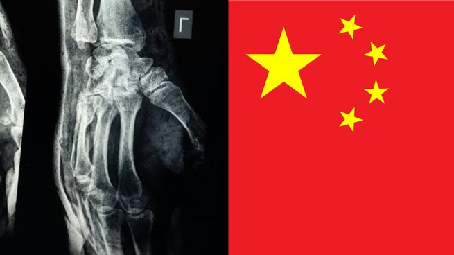 Revolución en ortopedia: un adhesivo biodegradable promete reparar fracturas sin cirugía invasiva.