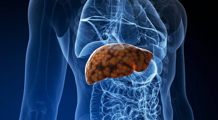 Fatty liver. Fatty liver.