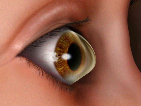 alteraciones en la cornea.jpg