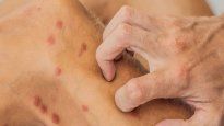 La lepra es una enfermedad infecciosa que se transmite por un agente patógeno denominado Mycobacterium leprae.