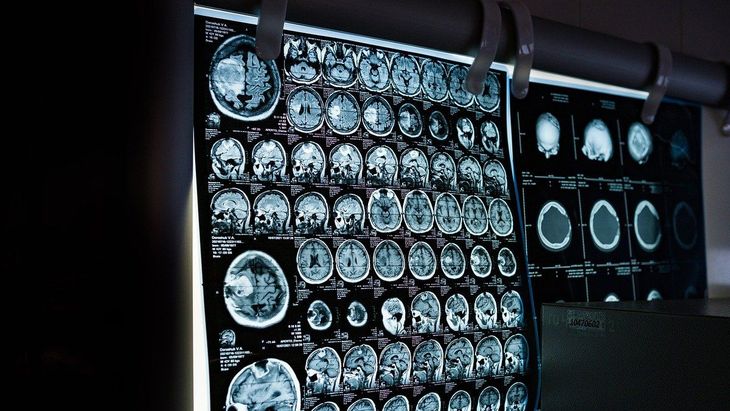 The work with the results of the phase 1 clinical trial was recently published in the prestigious journal The Lancet Oncology. The work with the results of the phase 1 clinical trial was recently published in the prestigious journal The Lancet Oncology.