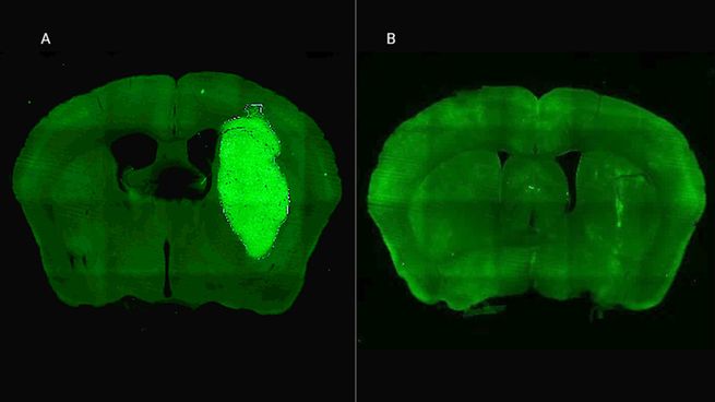 La investigación del CONICET identifica nuevas vías para aumentar la efectividad de tratamientos contra el cáncer cerebral más agresivo en adultos.