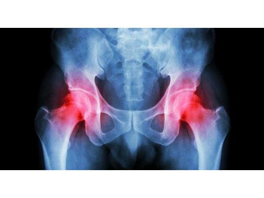 Cada día, 90 adultos mayores se fracturan la cadera